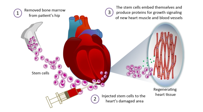 Image result for stemcell for heart